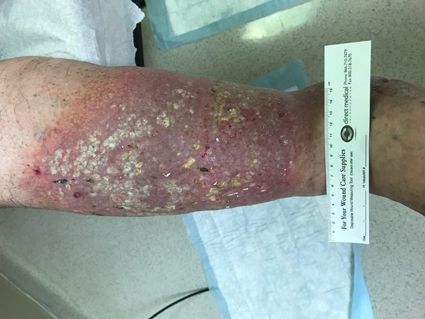 2. Venous ulcer and stasis dermatitis right lower leg