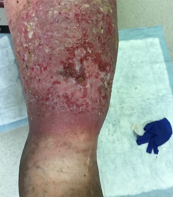 3. Superficial venous ulcer with irregular margins 