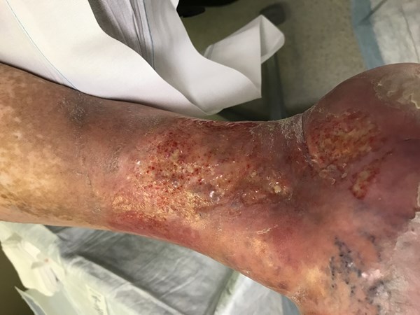 6. Highly exudative venous ulcer with fibrin tissue