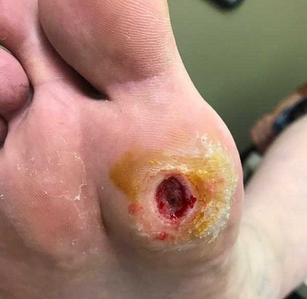 Diabetic foot ulcer. By Scott Robinson, MD