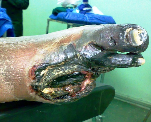 Extensive gangrene. By آرمین [CC0], from Wikimedia Commons