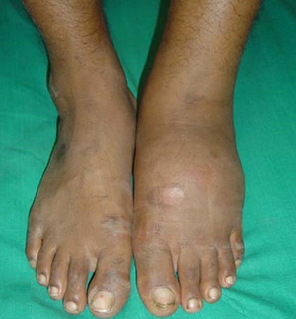 Charcot arthropathy. By J. Terrence Jose Jerome, https://creativecommons.org/licenses/by/3.0
