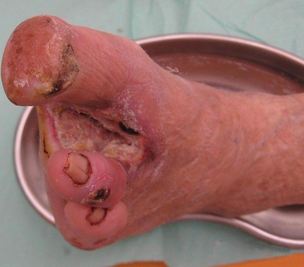 DFU probing to bone. Intermedichbo, https://creativecommons.org/licenses/by-sa/3.0/rs/deed.en