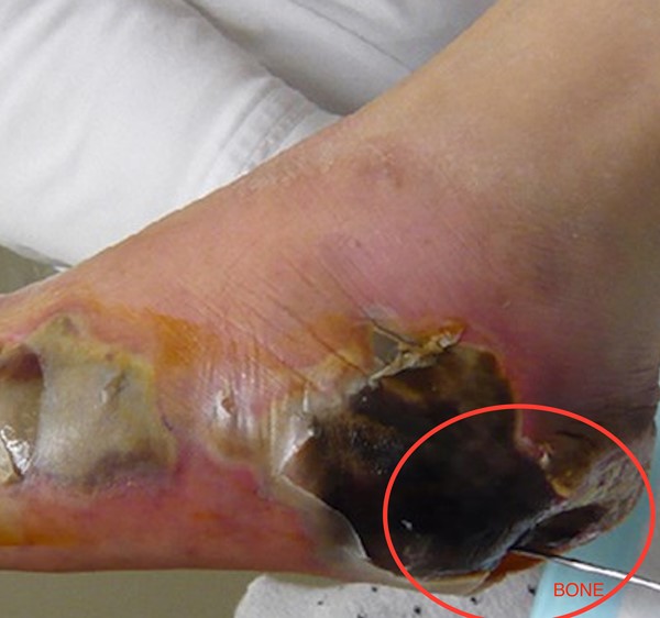 Diabetic foot ulcer, probe-to-bone. By CNX OpenStax, https://creativecommons.org/licenses/by/4.0