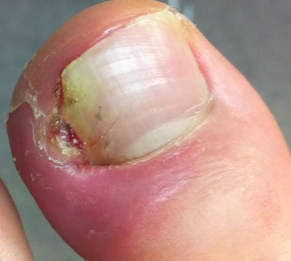 Superficial infection, diabetic foot ulcer