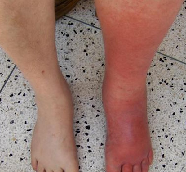 Cellulitis, diabetic foot ulcer