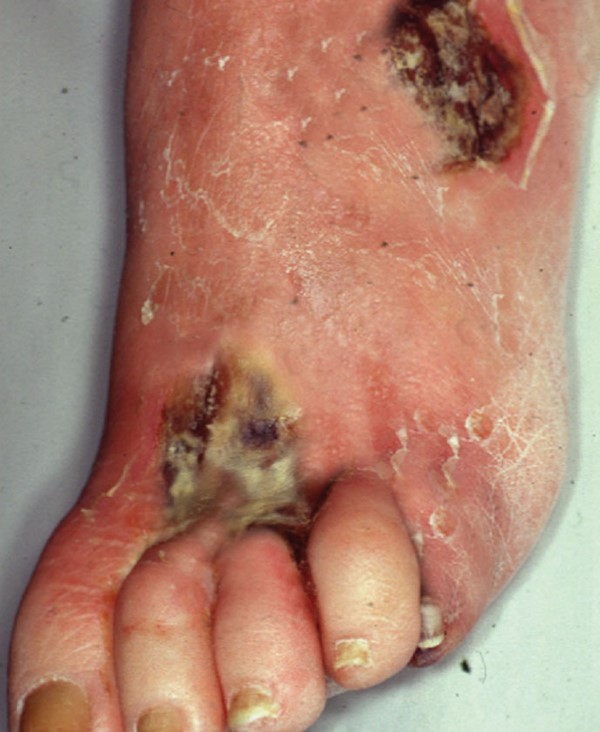 Diabetic foot, superficial infection and ischemia. By Verschluss, Wikimedia Commons