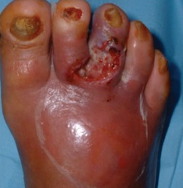 Diabetic foot with infection and no ischemia