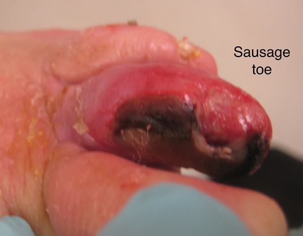Diabetic foot, sausage toe. By Nataliya Lebendiskaya, RN, BSN, CWOCN