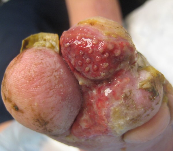 Diabetic foot superficial ulcer, ischemic foot. By Nataliya Lebendiskaya, RN, BSN, CWOCN