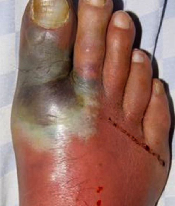 Diabetic foot, no ulcer, infected and ischemic