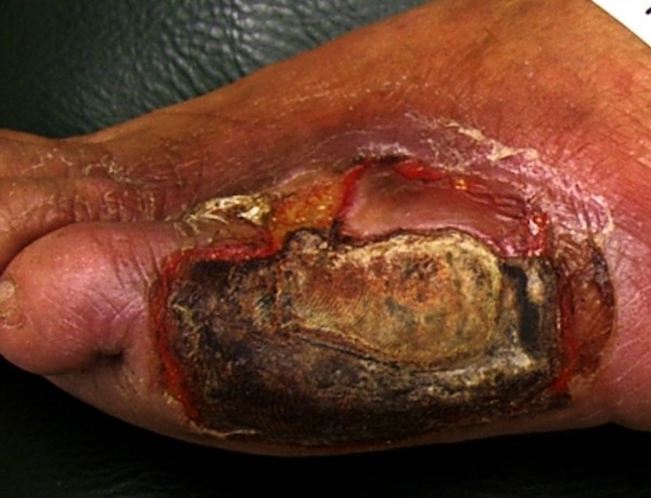 Diabetic foot ulcer, ischemic, infected. By DrGnu, Wikimedia Commons