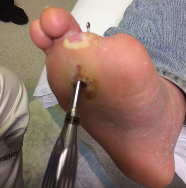 Deep diabetic foot ulcer, positive probe to bone