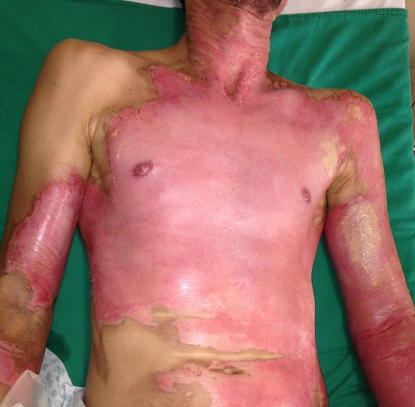 Partial-thickness wound (acute burn)