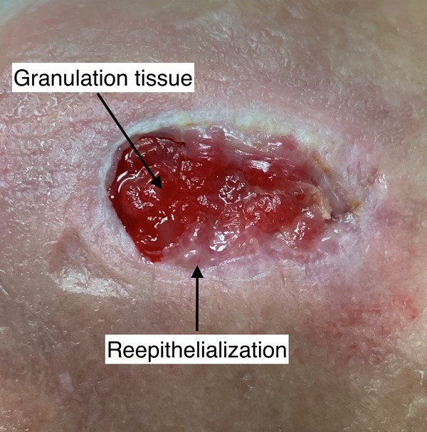 Granulation tissue and re-epithelialization