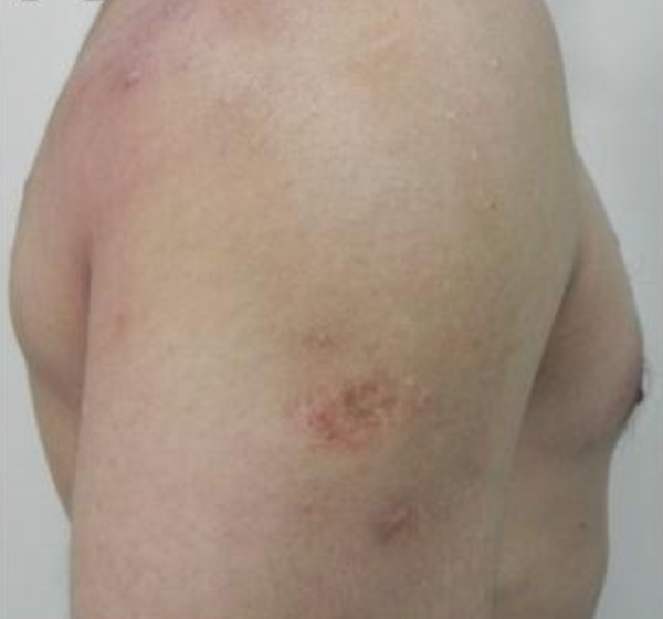 Atrophic epidermal scar due to  vaccine  