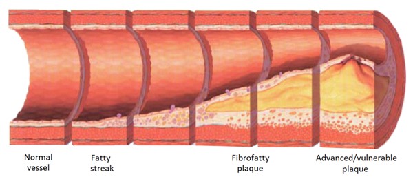 Development of atherosclerosis