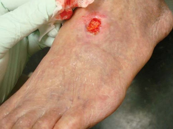 Arterial ulcer by Jonathan Moore / CC BY
