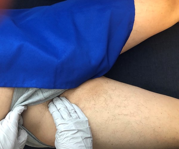 Palpation of the femoral pulse