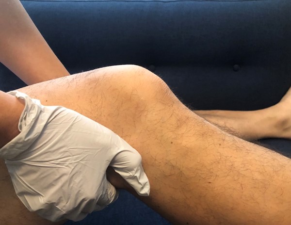 Palpation of the popliteal pulse