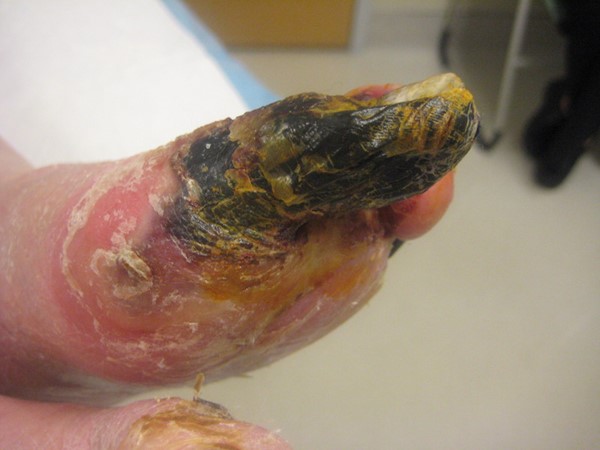Dry gangrene