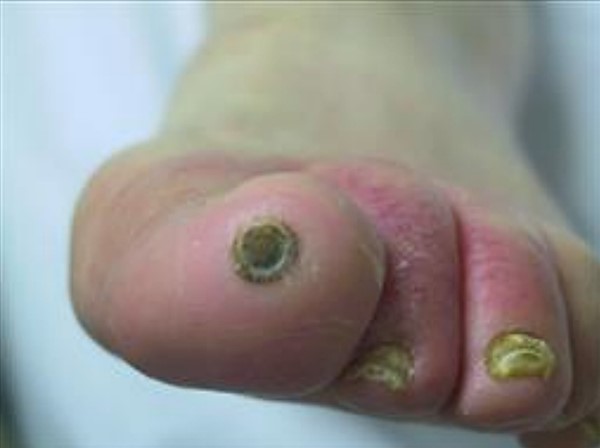 Pure arterial ulcer. By Worth E.