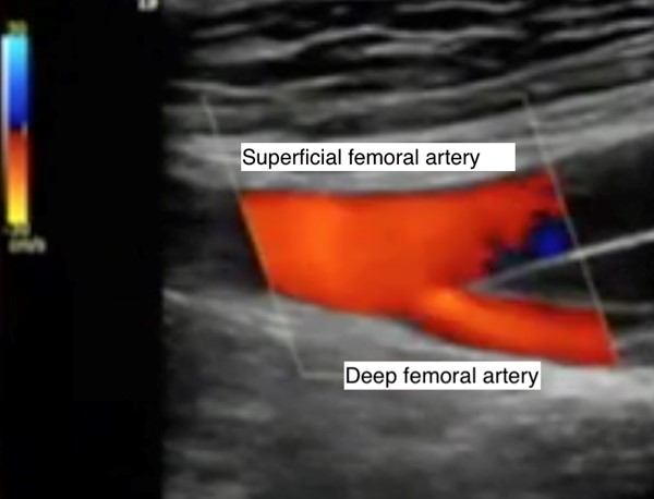 Duplex ultrasound imaging - femoral artery