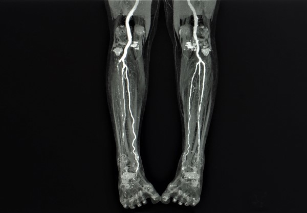 Computed tomography angiography of the legs