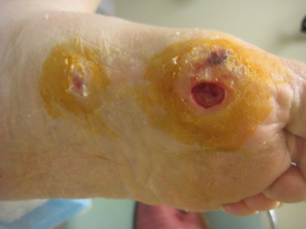 Diabetic foot ulcer. By Lebedinskaya N