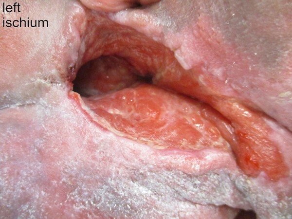 Pressure ulcer/injury. By Lebedinskaya N