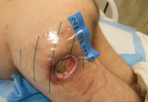 1b. Draping periwound