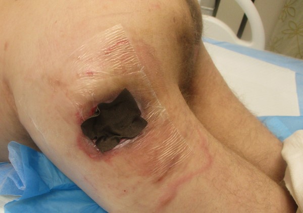  1d. Applying nonadherent antimicrobial layer (Acticoat Flex 3)