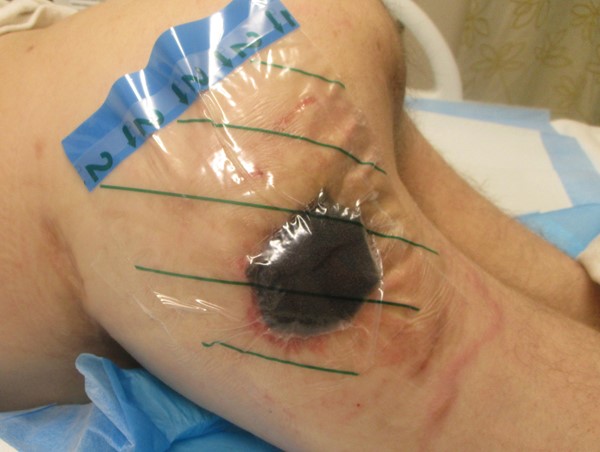 1e. Foam applied and draped over