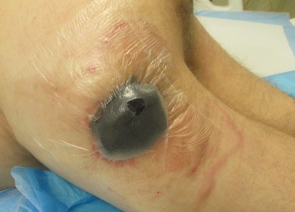 1f. Opening for suction tubing