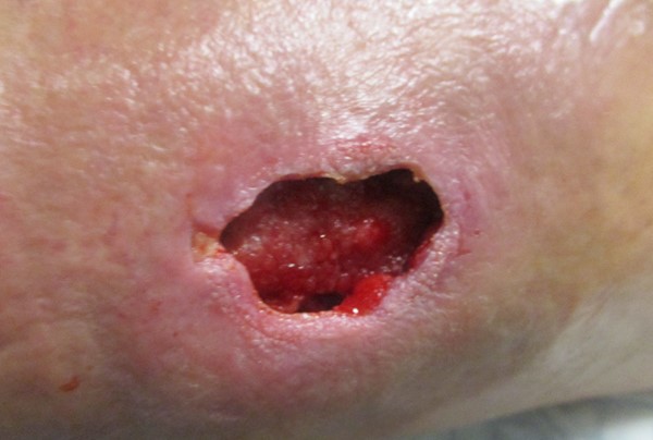 2a. Lower limb ulcer of traumatic etiology