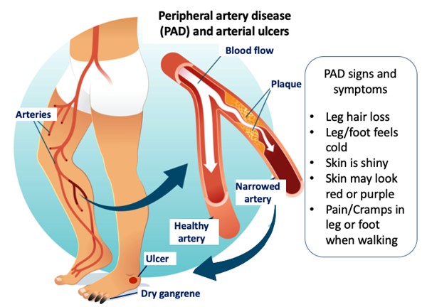Peripheral artery disease and arterial ulcers