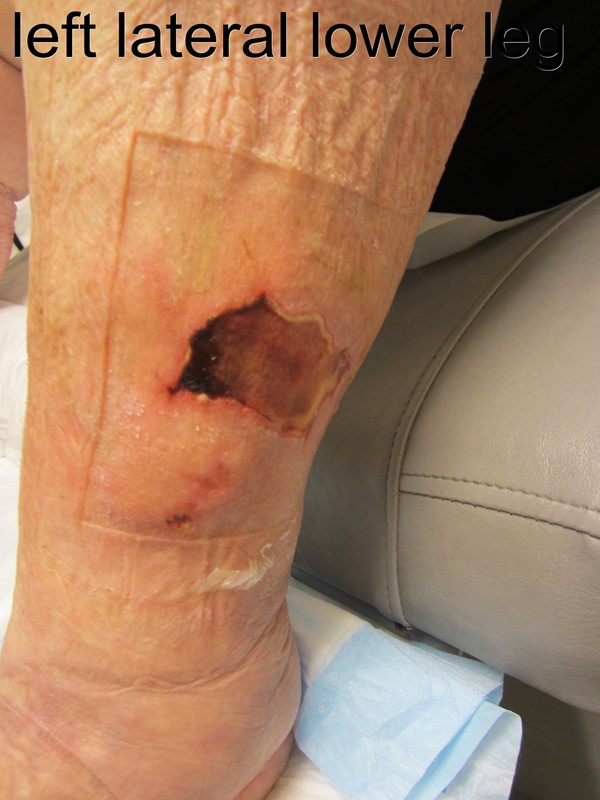 4. Ulcer left lateral lower leg