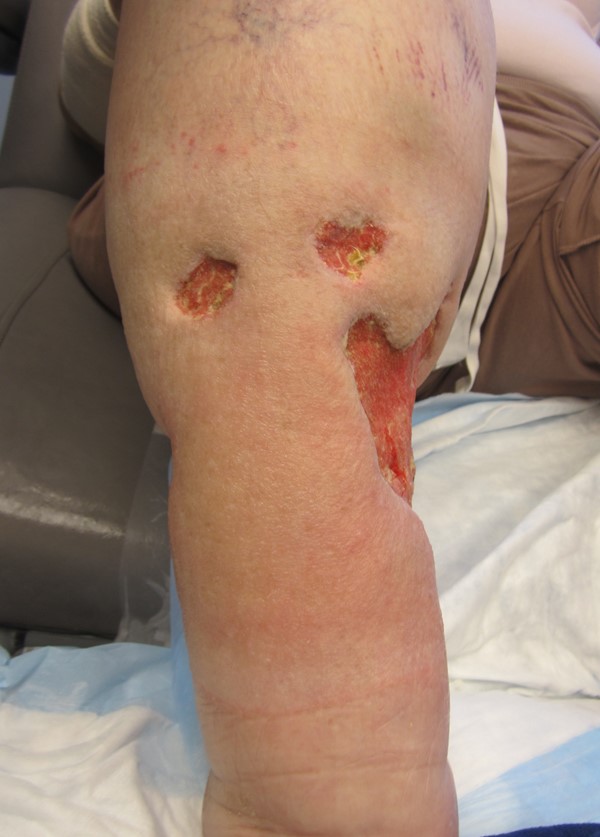 2. Ulcers in right lower leg 