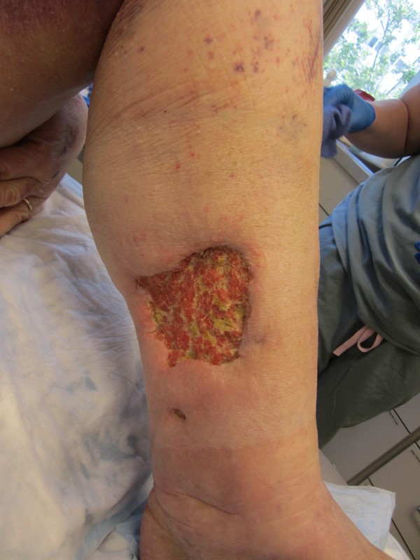 3. Ulcer in left medial lower leg