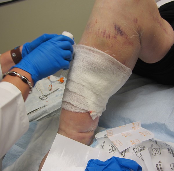 5. Saline-moist antimicrobial gauze on periwound film  