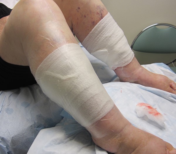 6. Film applied over moist gauze