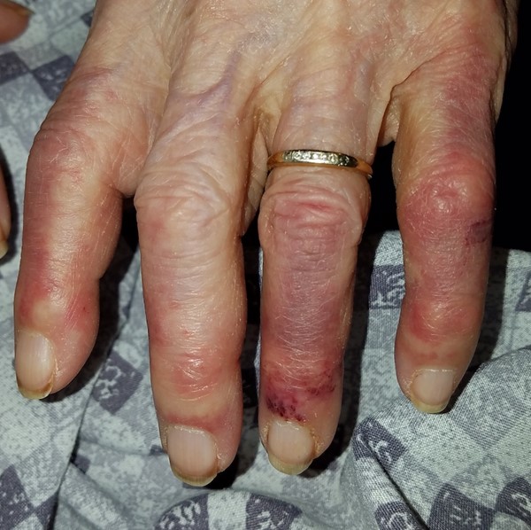 Pernio (chilblain)-like acral lesions. By Milne, C