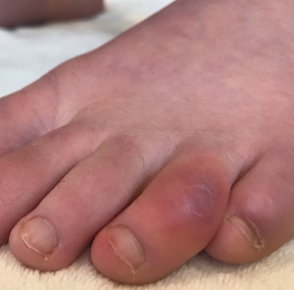 Pernio (chilblain)-like acral lesions. CC BY 4.0 McMahon D et al