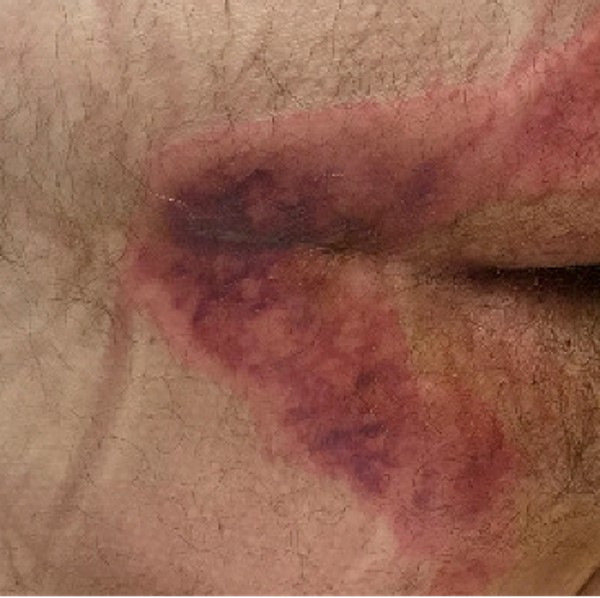 Livedo racemosa and retiform purpura CC BY 4.0 McMahon D et al