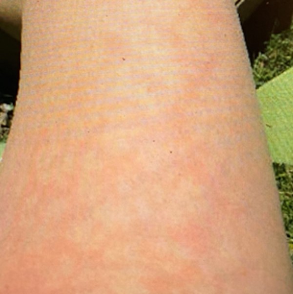 Livedo reticularis CC BY 4.0 McMahon D et al