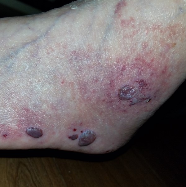 Hemorrhagic bullae and vasculitis. by Milne C