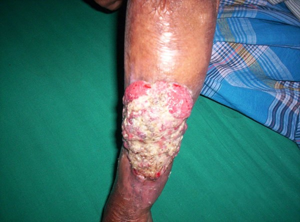 Marjolin ulcer