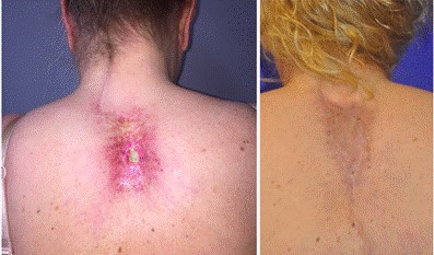 Chronic radiation-induced ulceration pre and post flap reconstruction