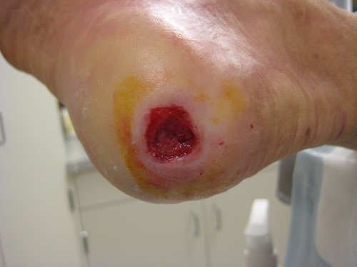 After conservative sharp wound debridement (CSWD)- stage 4 PU/PI 
