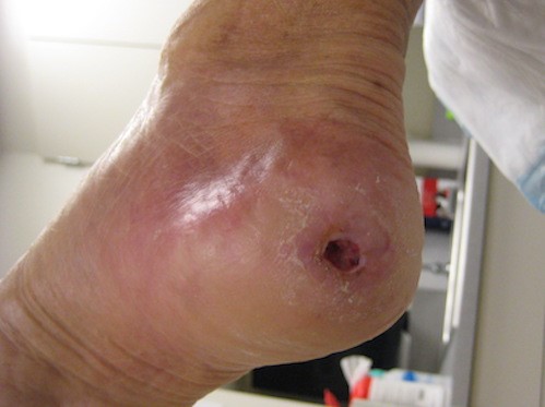 4 weeks after CSWD and appropriate treatment -decrease in wound size  
